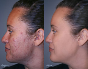 acne laser treatment cost