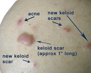 laser treatment for acne scars